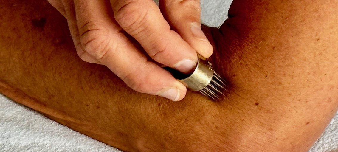  Baunscheidtverfahren